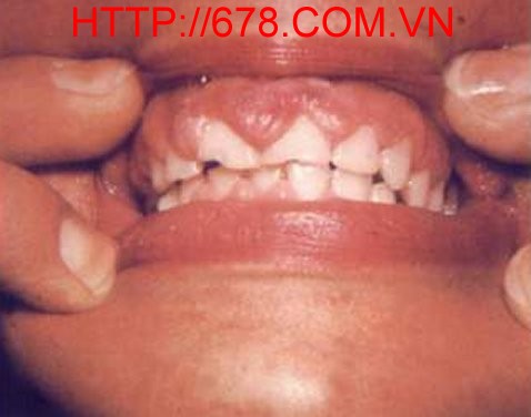 Sự tăng sản ở lợi răng do phenytoin